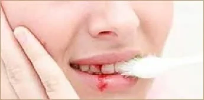牙龈出血03